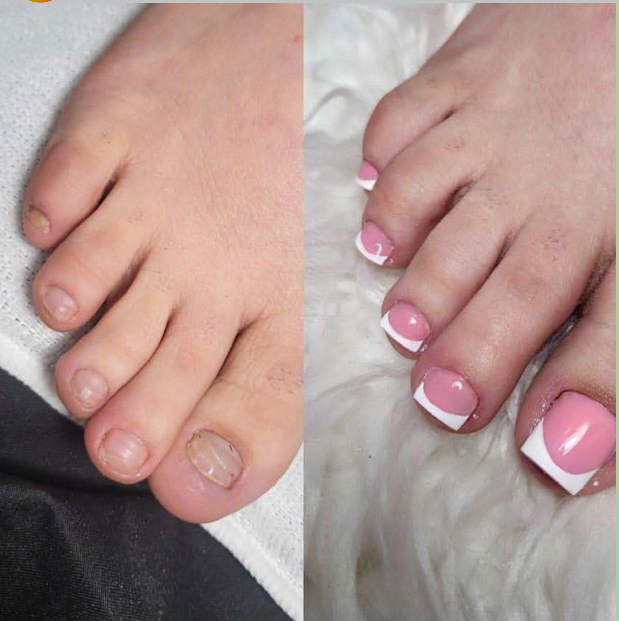 Toenail reconstruction by Nessa's Touch Salon